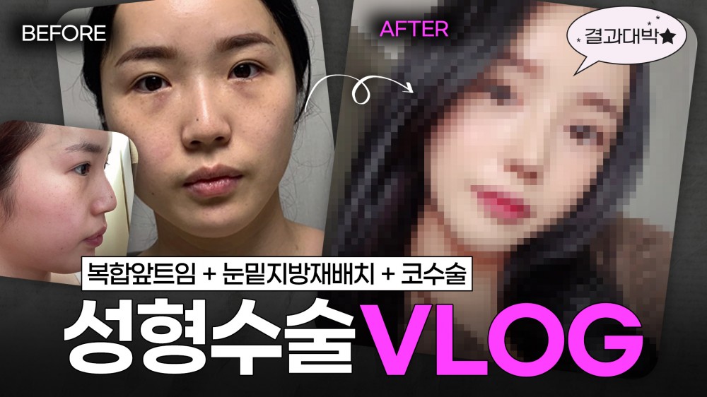 코성형+(복합)앞트임+눈밑지방재배치 1년차 후기