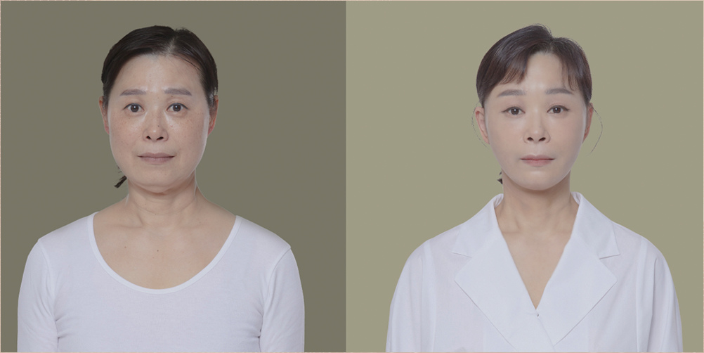 순플러스 수술 전후사진