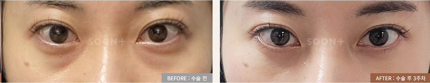 눈밑지방재배치 전후 사례 3
