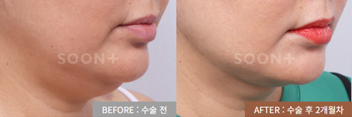 지방 때문에 생긴 턱살 미니거상 수술 전후 2개월 사례