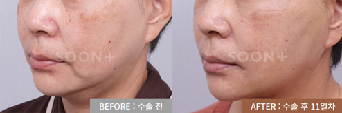 내려온 볼살과 입가 그림자 미니거상 수술 전후 11일 사례