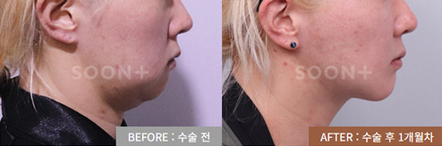 울퉁불퉁한 턱선 미니거상 수술 전후 1개월 사례