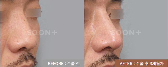 남자 코성형 수술 전후 사례
